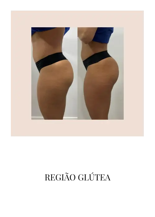 regiao-glutea-1m.webp