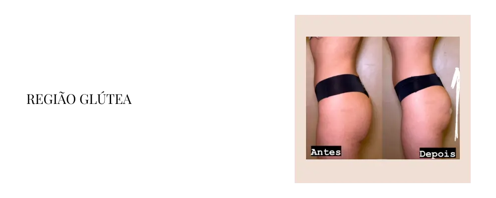 regiao-glutea-2.webp