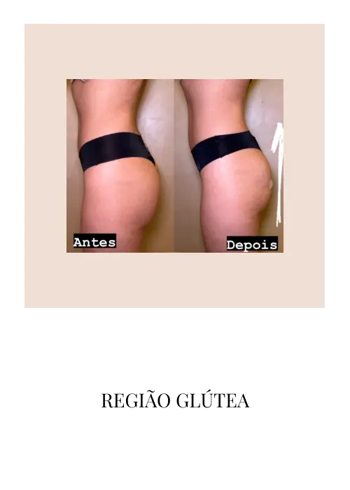 regiao-glutea-2m.webp