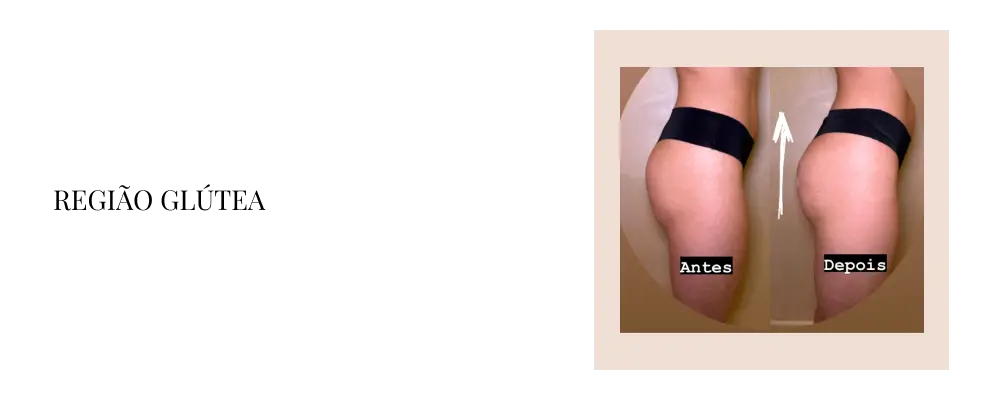 regiao-glutea-3.webp