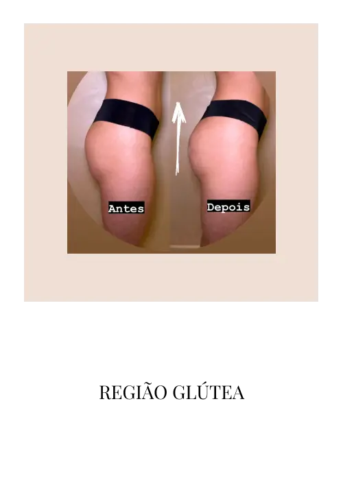 regiao-glutea-3m.webp